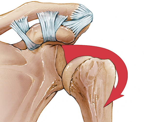 Shoulder instability